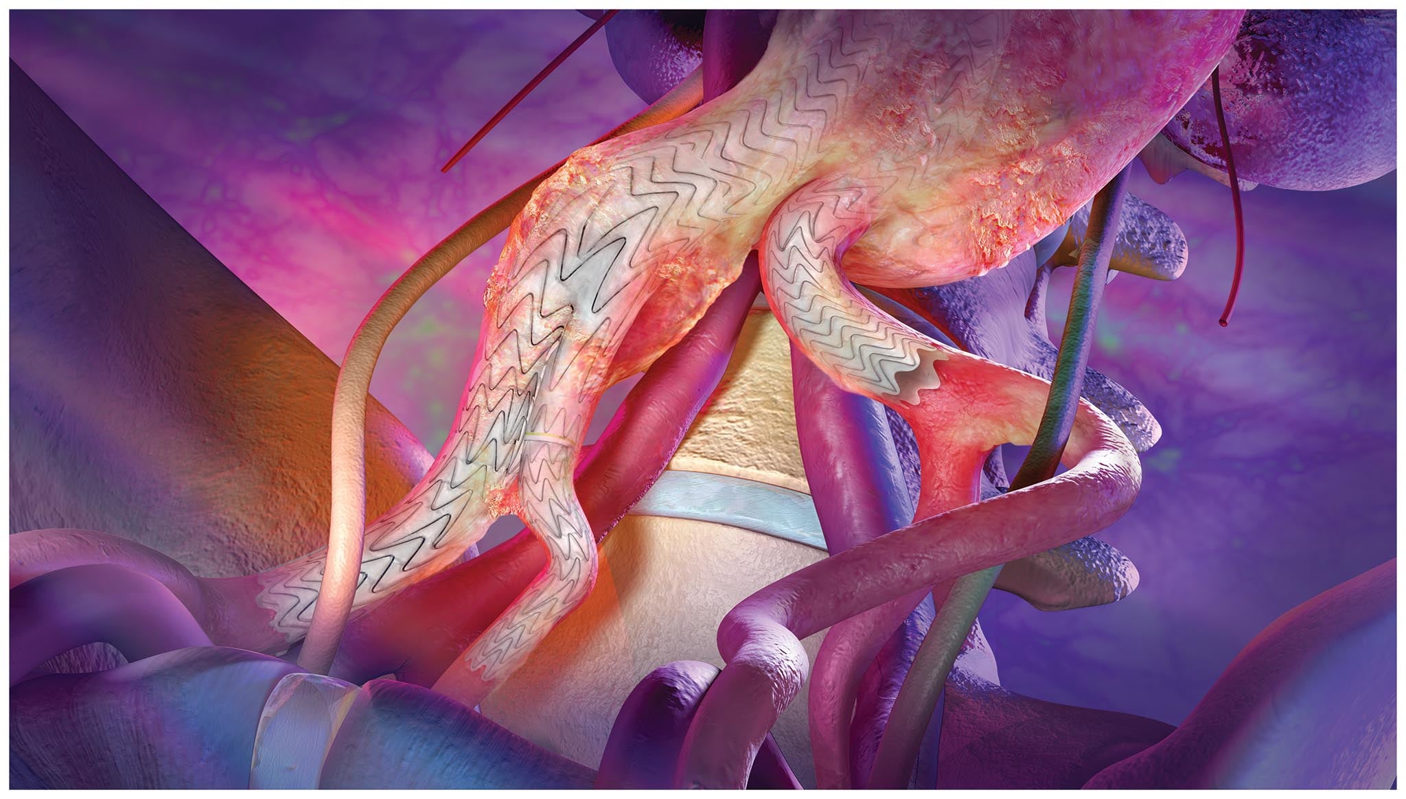 Aortic