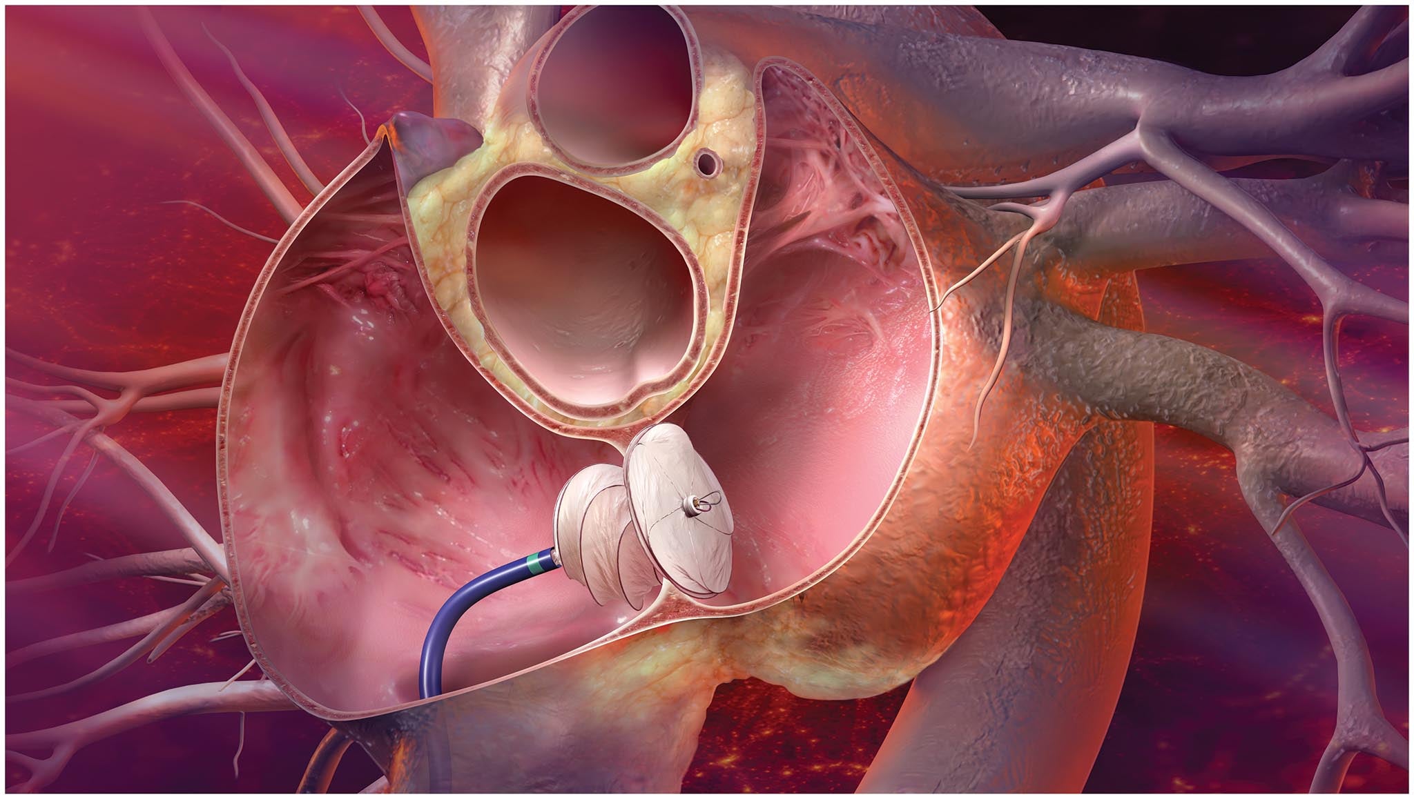 Cardiac, Structural Heart, GCSO, PFO, ASD, CARD, Art, Illustration, Kasnot, Deployment